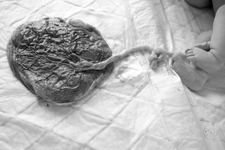 lotusbevalling waarbij baby en placenta aan elkaar blijven