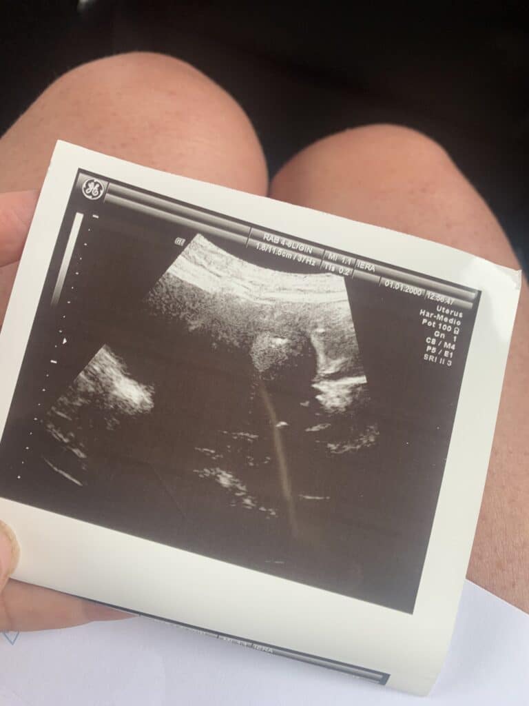 Annemarie koos voor moeder worden van een donor